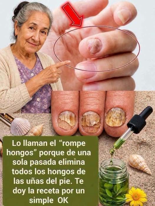 Rompe hongos remedios caseros