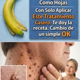 Remedios naturales para verrugas