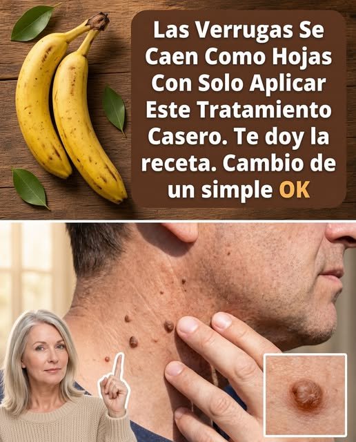 Cáscara de plátano para el tratamiento de verrugas