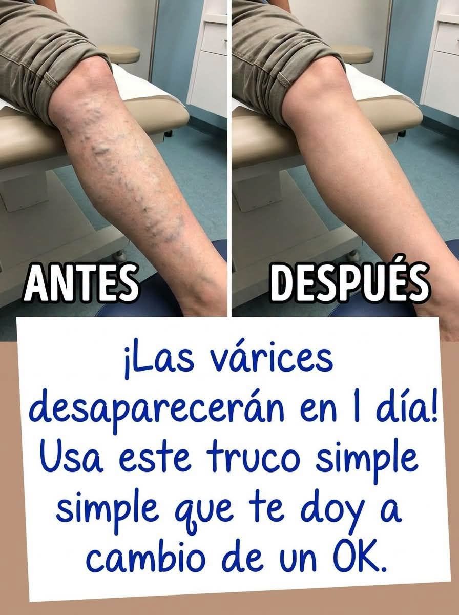Antes y Después de la Pierna con Várices
