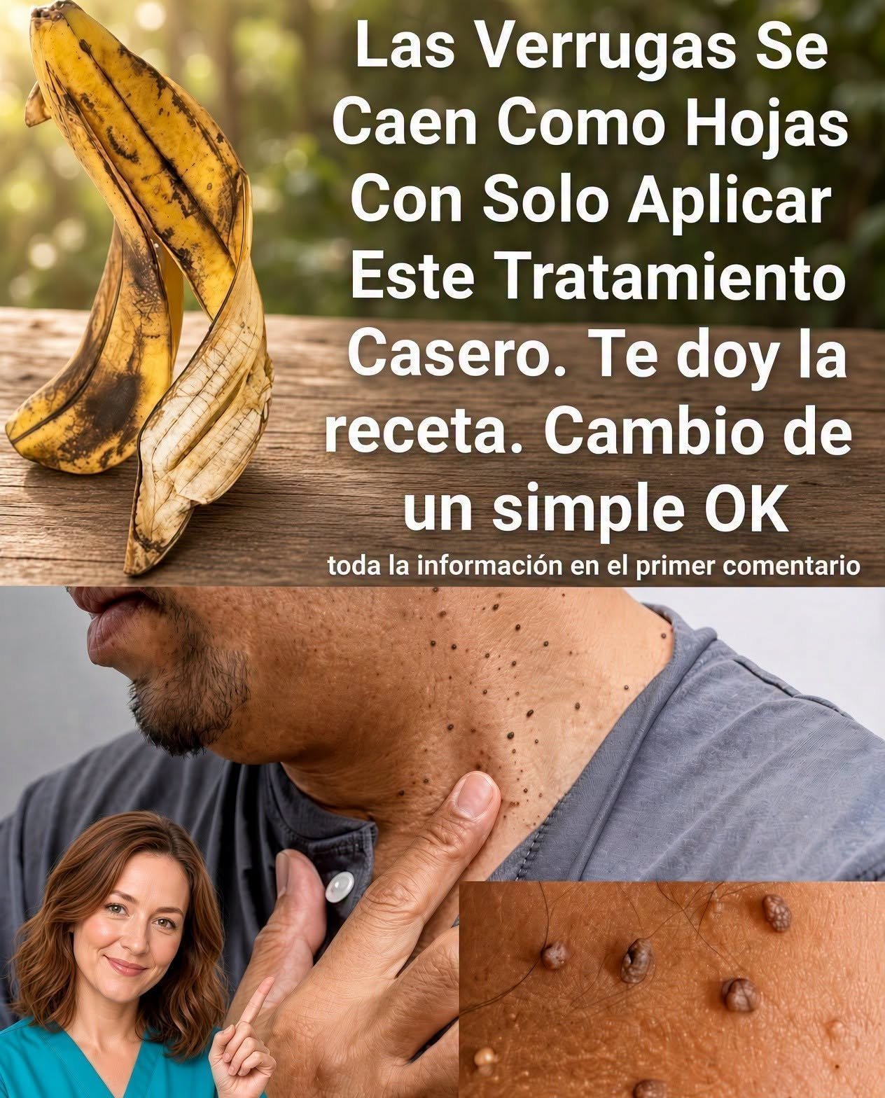 Tratamiento casero para verrugas