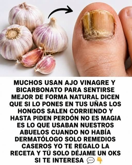 Remedio casero con ajo para hongos en las uñas