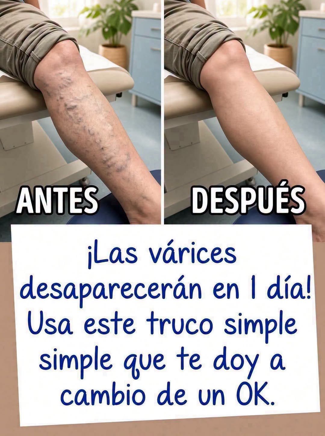 Varices en piernas